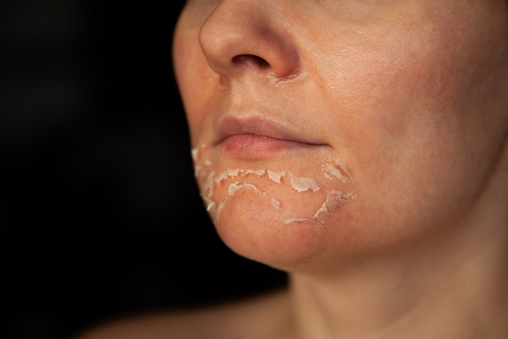 Close-up of Person's Face with Peeling Skin