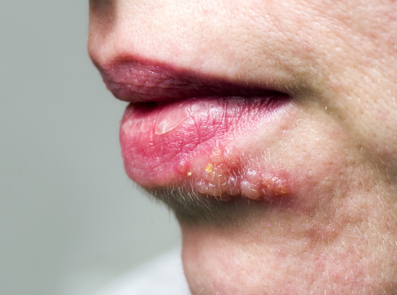 Herpes on lip